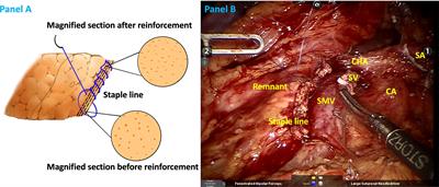 Staple line lockstitch reinforcement decreases clinically relevant pancreatic fistula following distal pancreatectomy: Results of a propensity score matched retrospective analysis